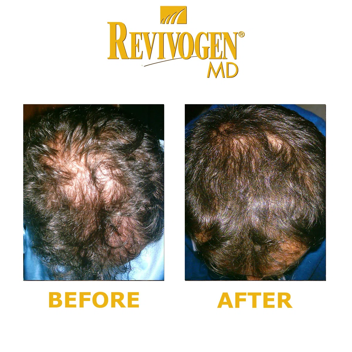 REVIVOGEN MD Scalp Therapy Solution naturelle contre la perte de cheveux pour cheveux fins