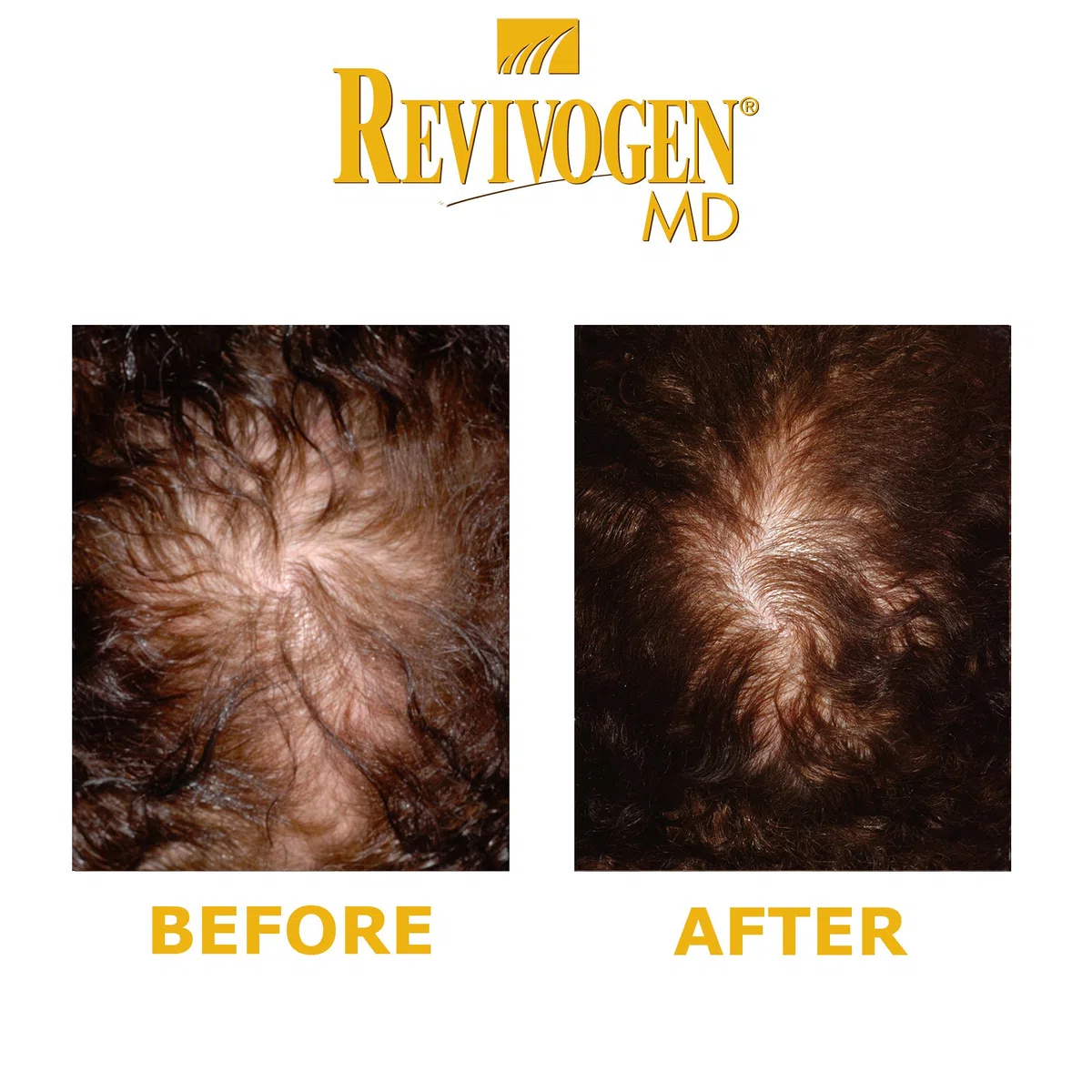REVIVOGEN MD Scalp Therapy Solution naturelle contre la perte de cheveux pour cheveux fins